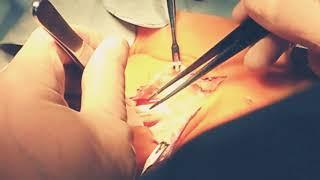 Dupuytren's disease (Dupuytren's contracture) Surgical Treatment Dr. Mavropoulos Rodion