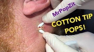 A quick popping session to hold you over! Shallow follicular cysts extracted. With Bonus blackhead