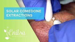 Solar Comedone Extractions