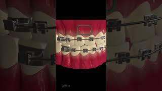 How Does Dental Braces Work