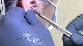 TRAGUS  PIERCING PROCEDURE BY DR.PIERCINGS