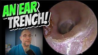 AN EAR TRENCH! 369 #ear #earwax #earwaxremoval #asmrearwax #satisfying #foryou #fyp #foryourpage