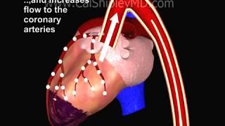 Cardiogenic Shock and Intra-aortic Balloon Pump by Dr. Cal Shipley, M.D.