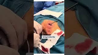 Port Catheter Placement Without Imaging: A Feasible Solution for Low-Resource Settings #thoracic