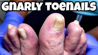 Trimming Dystrophic Toenails