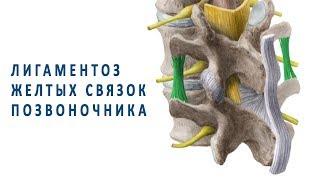 Лигаментоз желтых связок позвоночника