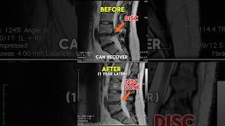 Real Life Example: Low Back Disc Herniation Can Heal