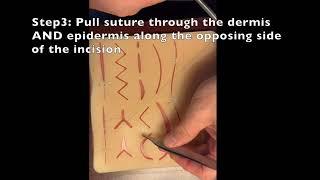 Modified Allgower Donati suture technique demo