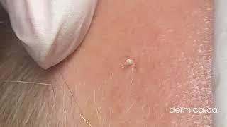 Milia Extraction on Forehead