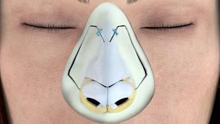 Piezotome® Rhinoplasty Protocol 3D