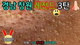 피지 직접 뽑아드렸습니다 _ 피지제거 블랙헤드제거 피지뽑기 _  23번째 모델이신 경남 창원의 레전드 모델 20대 취업준비생의 피지를 개박살냈습니다 3탄