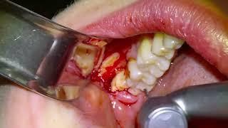 [33] Live Surgery Impacted Wisdom Tooth Extractions