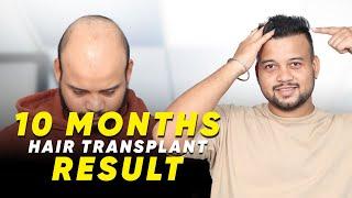 Hair Transplant in Hyderabad | Best Results & Cost of Hair Transplant in Hyderabad