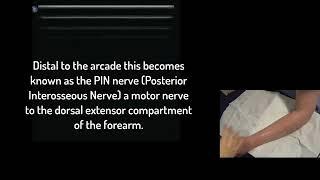 Deep br. Radial Nerve Ultrasound (PIN - Posterior Interosseous Nerve)  Supinator Arcade part 1.