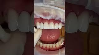 Smile Makeover by Dr. Tejas Patel #veneers #porcelainveneers #cosmeticdentistry #newteeth