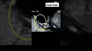 Club foot #radiology #pregnant #ultrasound #baby