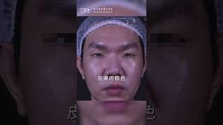 皮膚油腫又敏感？三大治療搞定！ #油性肌膚 #敏感肌 #皮脂腺 #蠕形蟎蟲 #暗沉肌 #口服A酸 #外用A酸 #舒利達