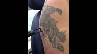 Eliminación de tatuajes en Bogotá - Innova Laser Center