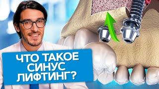 Что такое синус лифтинг? Что нужно знать о синус лифтинге и какие последствия ждут пациента?