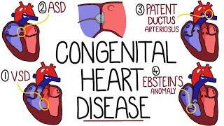 Congenital Heart Malformations Made Easy (8 Main Types)