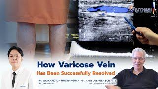 How Varicose Vein Has Been Successfully Resolved