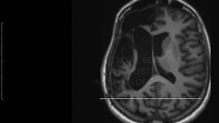 Post Stroke Gait and Postural Disturbances