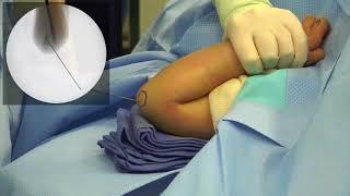 Closed Reduction and Percutaneous Pinning of Pediatric Supracondylar Humeral Fractures