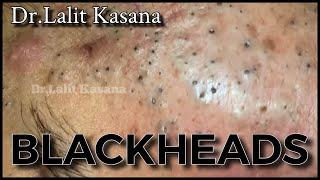 Best of Blackheads Removal by Dr Lalit Kasana / Repost