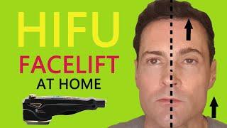 HIFU Face Lift At Home! Skin Tightening Device Review