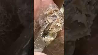 Diabetic Peripheral Neuropathy Can Lead To Thick Calluses