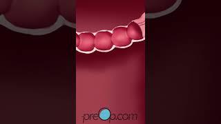 Colonoscopy Lower Endoscopy - PreOp® Patient Education & Patient Engagement #shorts