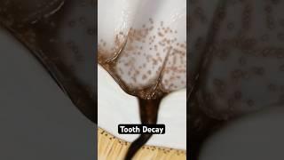 How decay destroys your teeth (3D Animation)