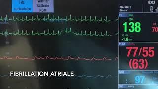 Traitement peropératoire de la Fibrillation Atriale (FA):