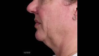 Deep Plane Facelift Results with Dr. Paul Nassif - 6 Months Post-Op