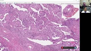 Sanjay Mukhopadhyay and Matt Cecchini Thoracic Survival Guide video