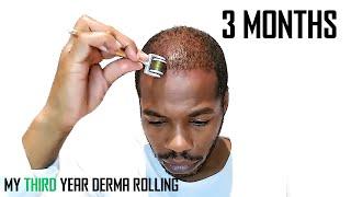 Derma Roller for Hair Growth Results 3 Months | Month by Month Progress | Coffee as a DHT Blocker