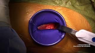 Alexis Orthopaedic Protector Placement During Direct Anterior Hip Arthroplasty