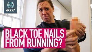 How To Stop Getting Black Toenails From Running!