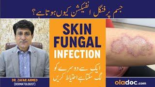 Jism Pe Fungus Ka Ilaj - Skin Fungal Infection Treatment - Ringworm On Skin - Dad Khad Ka Ilaj