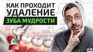 Как проходит удаление зуба мудрости. Первые 7 дней после удаления