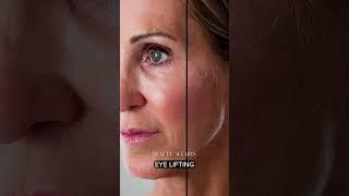 Before After Hifu liftera eye lifting treatment  #hifu #eyelift #medispa  #beautybrands #gybaio