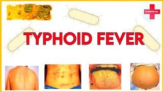 typhoid(enteric) fever||pathogenesis, symptoms, diagnosis and treatment ||pediatrics @ImMEDICAL.