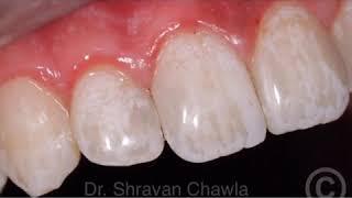 Cavities and decay in front teeth