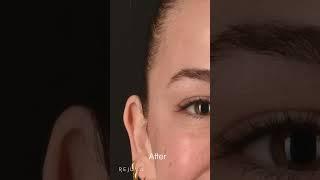 Struggling with Hollowed Temples? Try Sculptra!