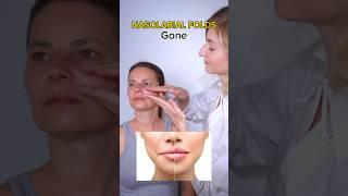 nasolabial folds gone! #smilelines #faceyogaexercises #facialyoga #facialfitness #facemassage