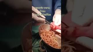 Ascaris worm from small intestine