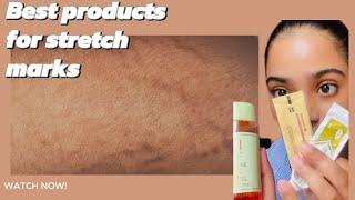 Bleaching ක්‍රීම්‍ ගාලාstretch marks ආපු අයට solution එක| stretch marks වලට හොදම විසදුම