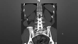 Normal variants in Imaging