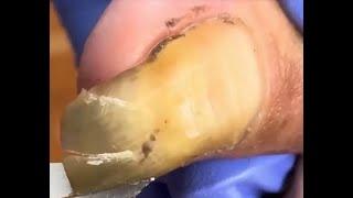 Super curly ingrown toenail silky triming #fungustoenail  #toenail #fungus #pedicure