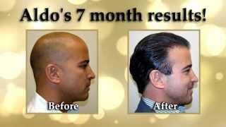 Dr. Brett Bolton Hair Transplant Surgery